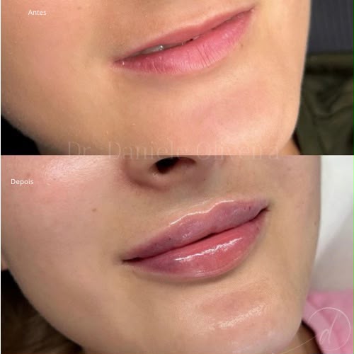 Antes e depois de paciente da Dra. Daniele